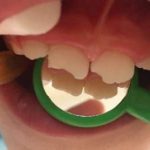 درمان ضربات وارده به دهان و دندان