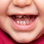 تغییر رنگ دندان به علت استفاده از قطره آهن